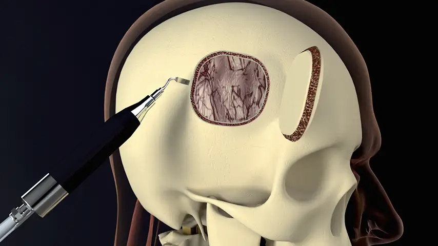 Craionotomy and cariectomy