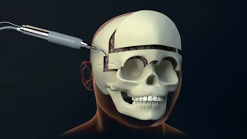 Cranioplasty<br />
and reshaping of frontoorbital bandeau