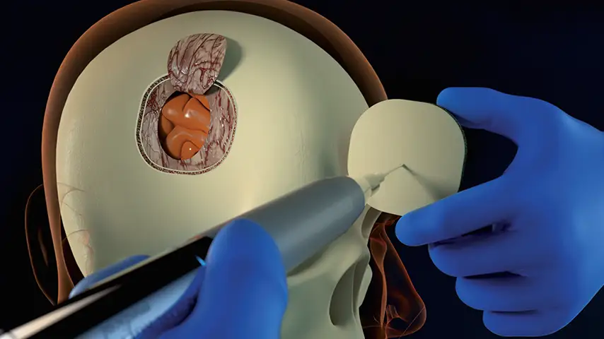 Drilling a hole<br />
for dural suspension