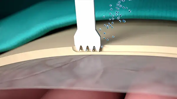 Selective cut preserves soft tissue. (Dura, neves and vessels)
