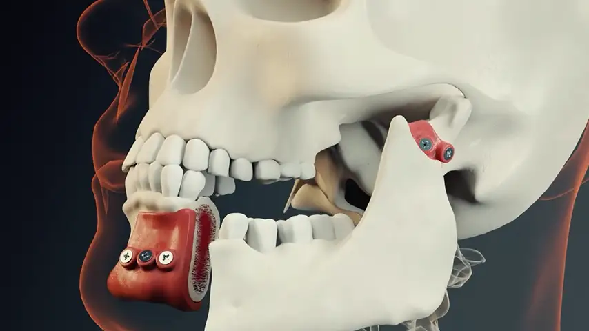 Greater intraoperative control and bone management