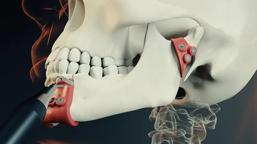 Craionotomy and cariectomy