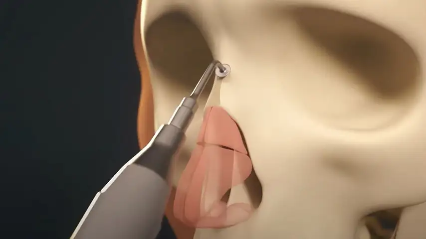 Endoscopic transsphenoidal approach