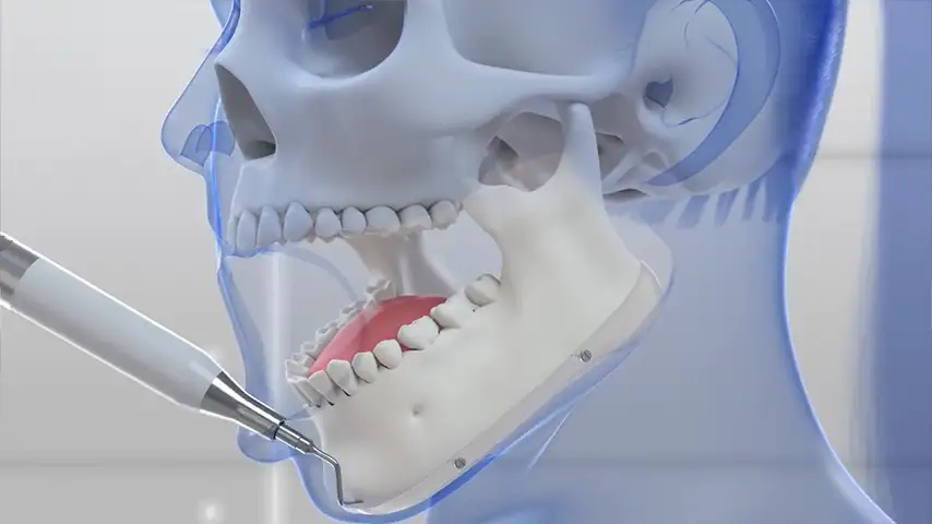 Feminization Surgery 