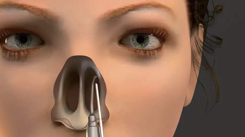 DCR (Dacryocystorhinostomy)