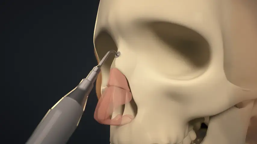 Hump takedown and dorsum modeling