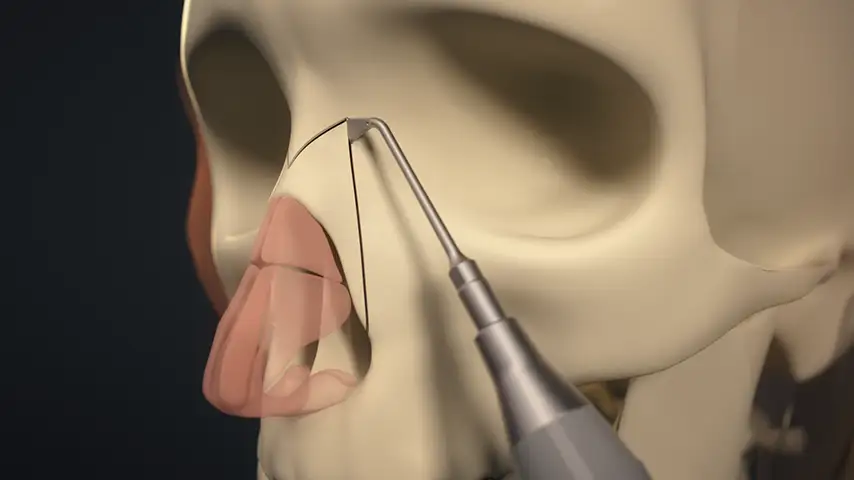 Lateral osteotomy of nasal bone