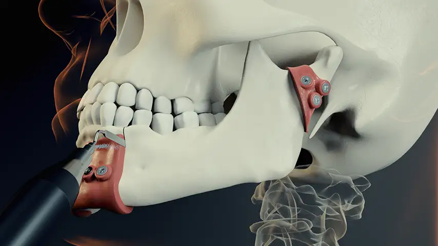Mandibulotomy and mandibulectomy - maxillectomy