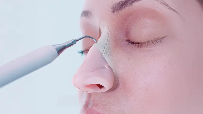 Nose feminization (REVONose®)