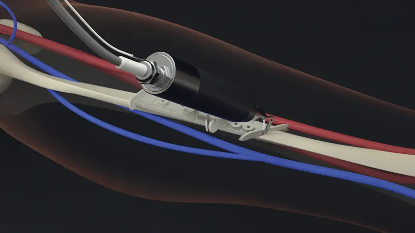 Osteotomies for harvesting and remodelling