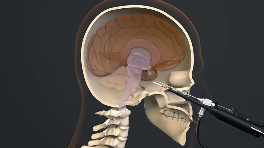 Posterior sphenoidotomy for pituitary tumor removal