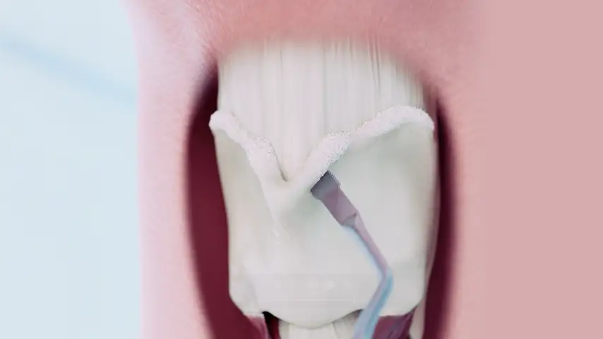 Tracheal shave (TContour®)