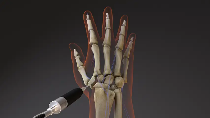 Scaphoid Fractures and Non-unions